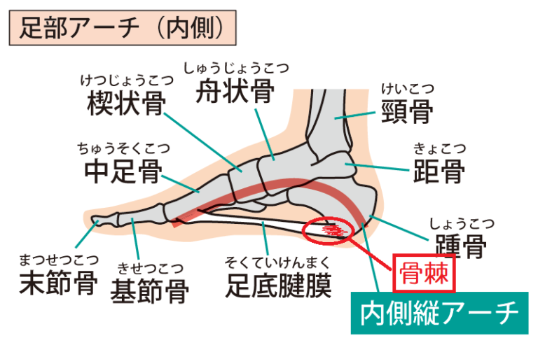足の骨棘の原因
